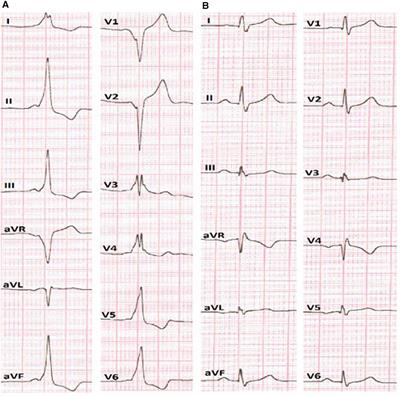 Case Report: Focal cryoablation vs. radiofrequency ablation in a pediatric patient with para-Hisian accessory pathway with effect from the non-coronary aortic cusp